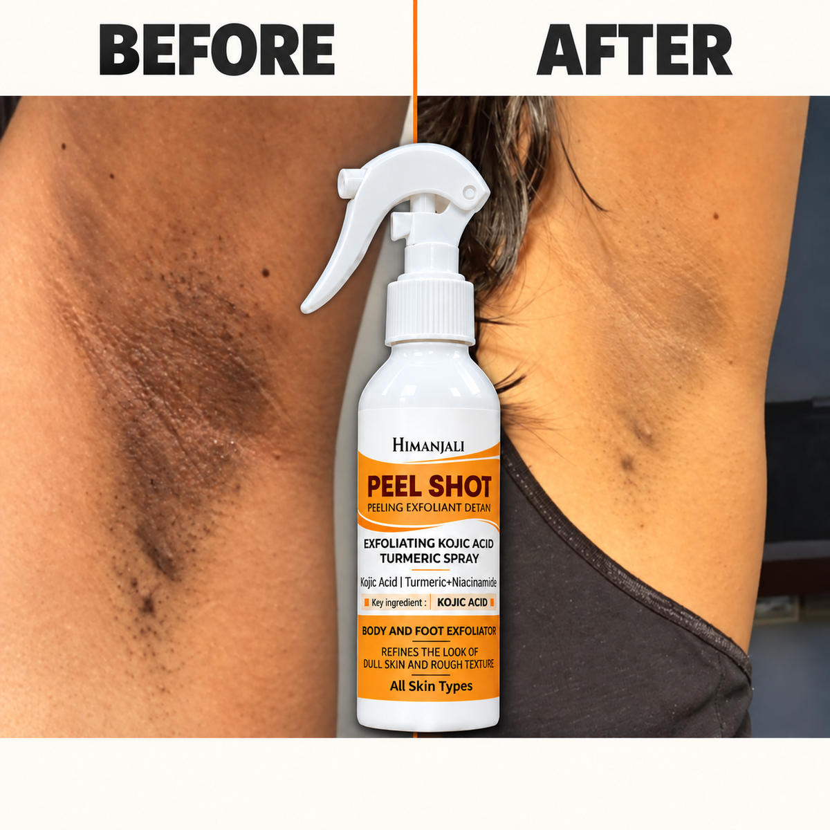 Himanjali Peel Shot – Kojic Acid & Turmeric Body Exfoliating Spray